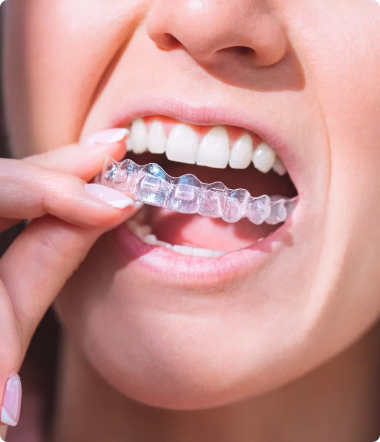 Who is eligible for Invisalign?