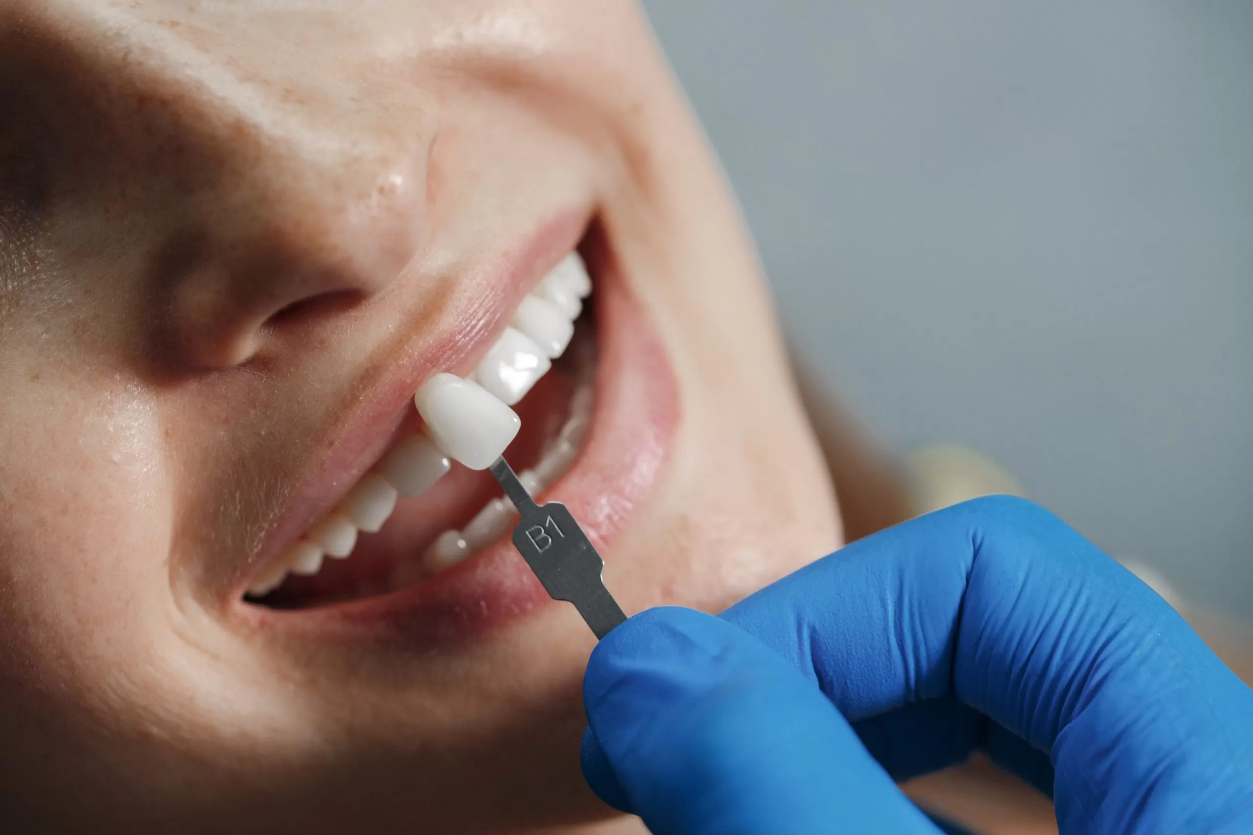 Caring for Dental Crown: Tips and Best Practices for Long-lasting Restorations