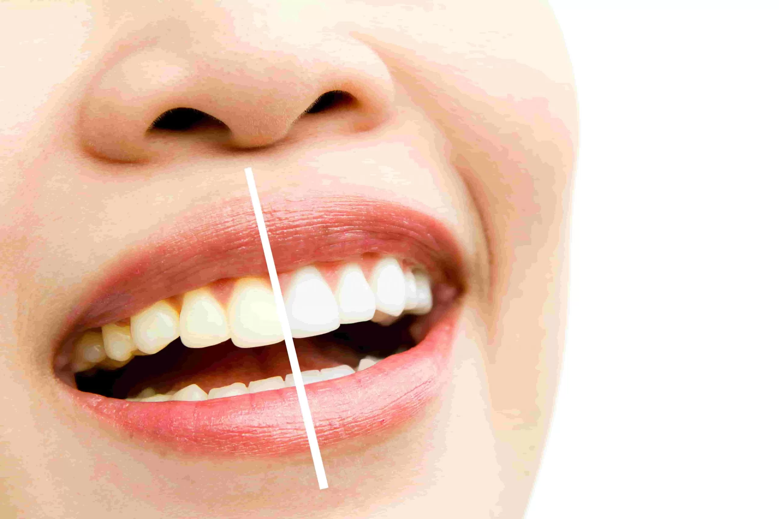 How to Achieve a Brighter Smile: The Ultimate Guide to Teeth Whitening
